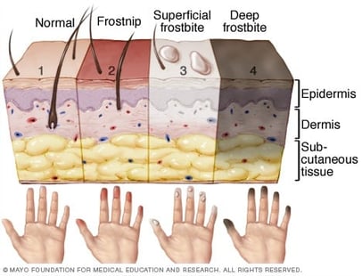 Signs of Frostbite